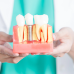 London Implant Specialists Share 6 Benefits of Same-Day Teeth
