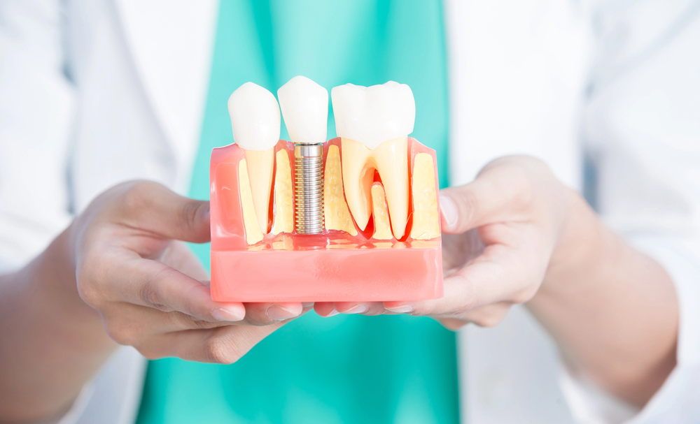 London Implant Specialists Share 6 Benefits of Same-Day Teeth